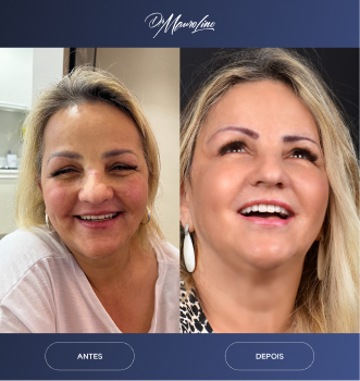 antes-e-depois-01.webp